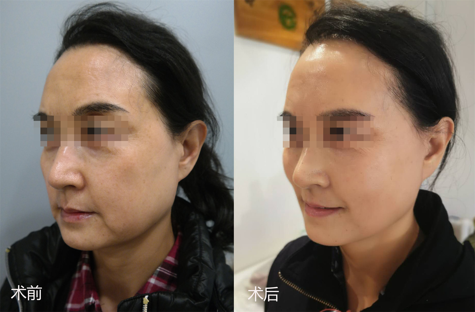 为什么很多“线雕粉”最后都倒戈“拉皮手术”？