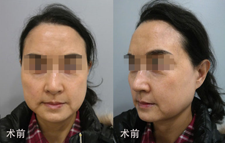 63岁真人拉皮案例分享，术后1个月难掩喜悦之情