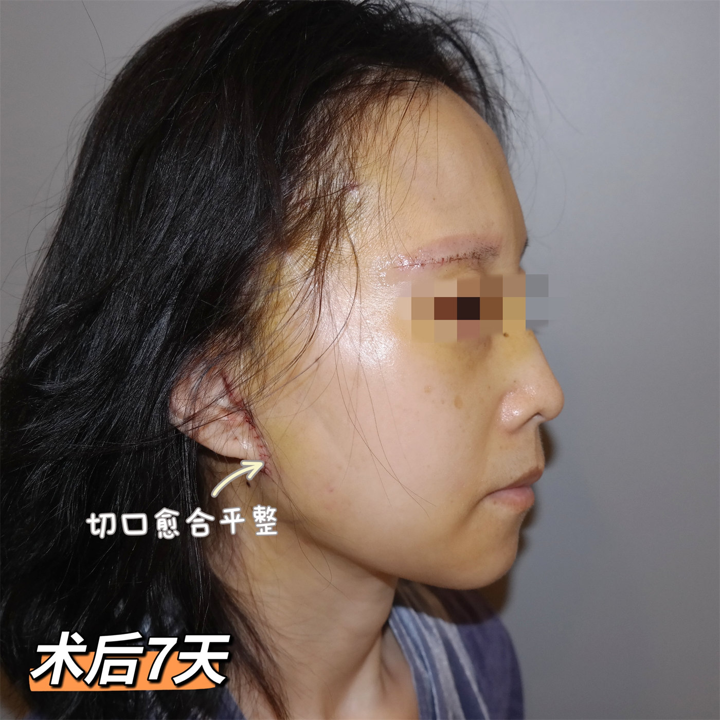 案例日记|53岁艺术院校教师，拉皮术后直接减龄15岁