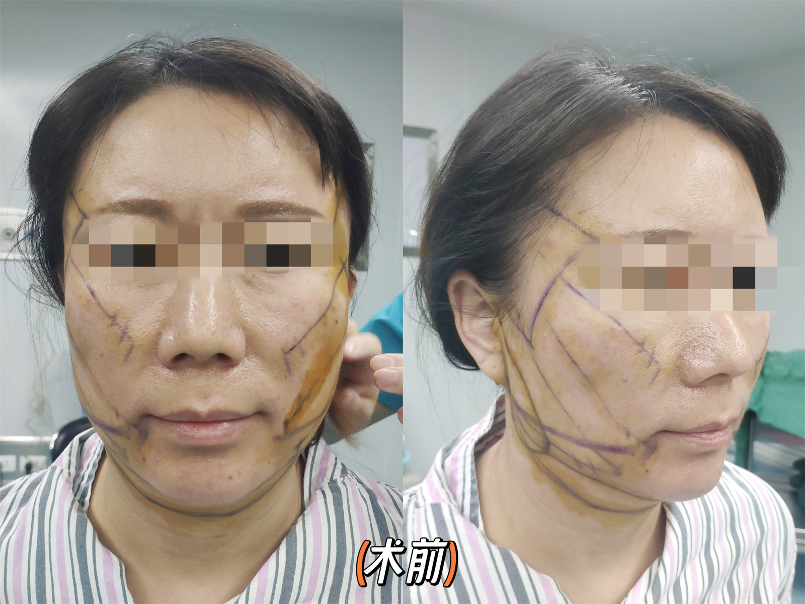 拉皮提升抗衰效果怎么样？两个案例供您参考