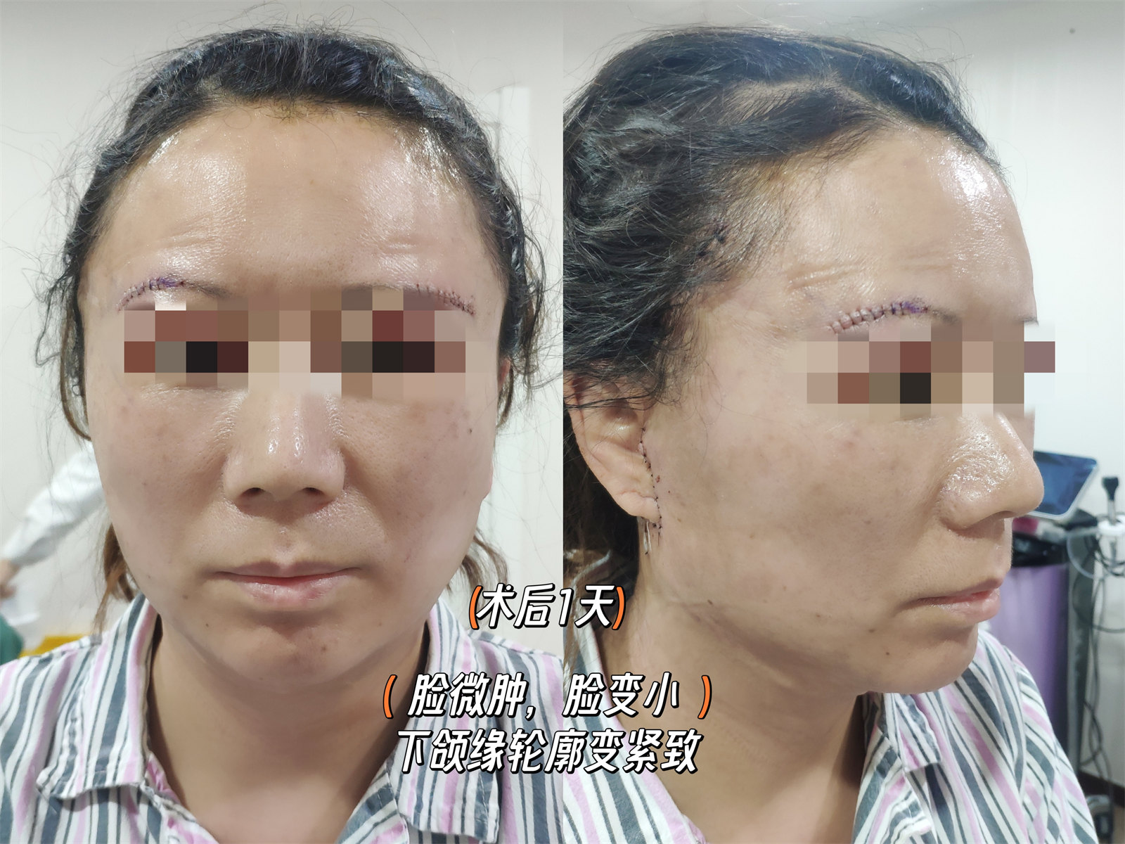 拉皮提升抗衰效果怎么样？两个案例供您参考