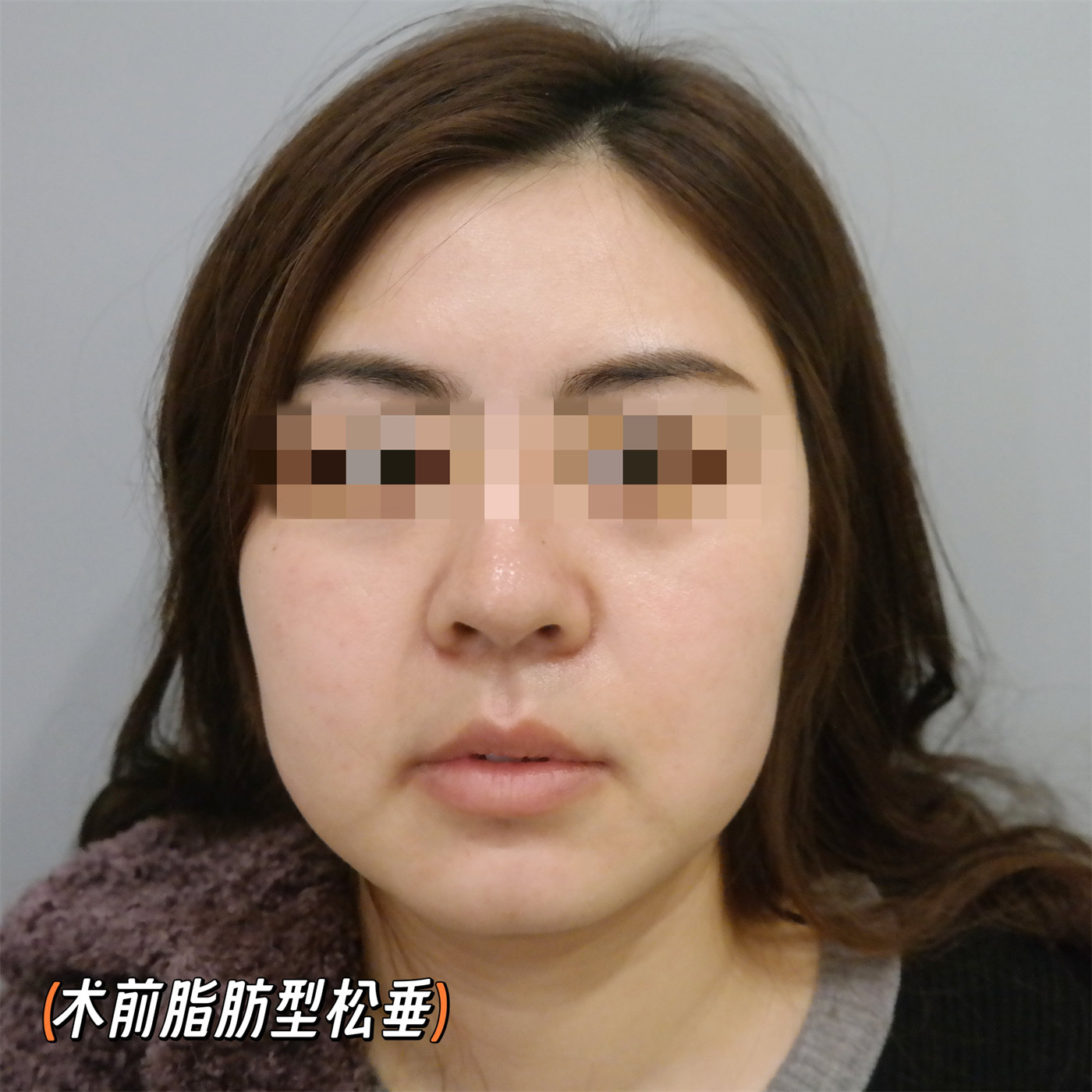拉皮提升抗衰效果怎么样？两个案例供您参考
