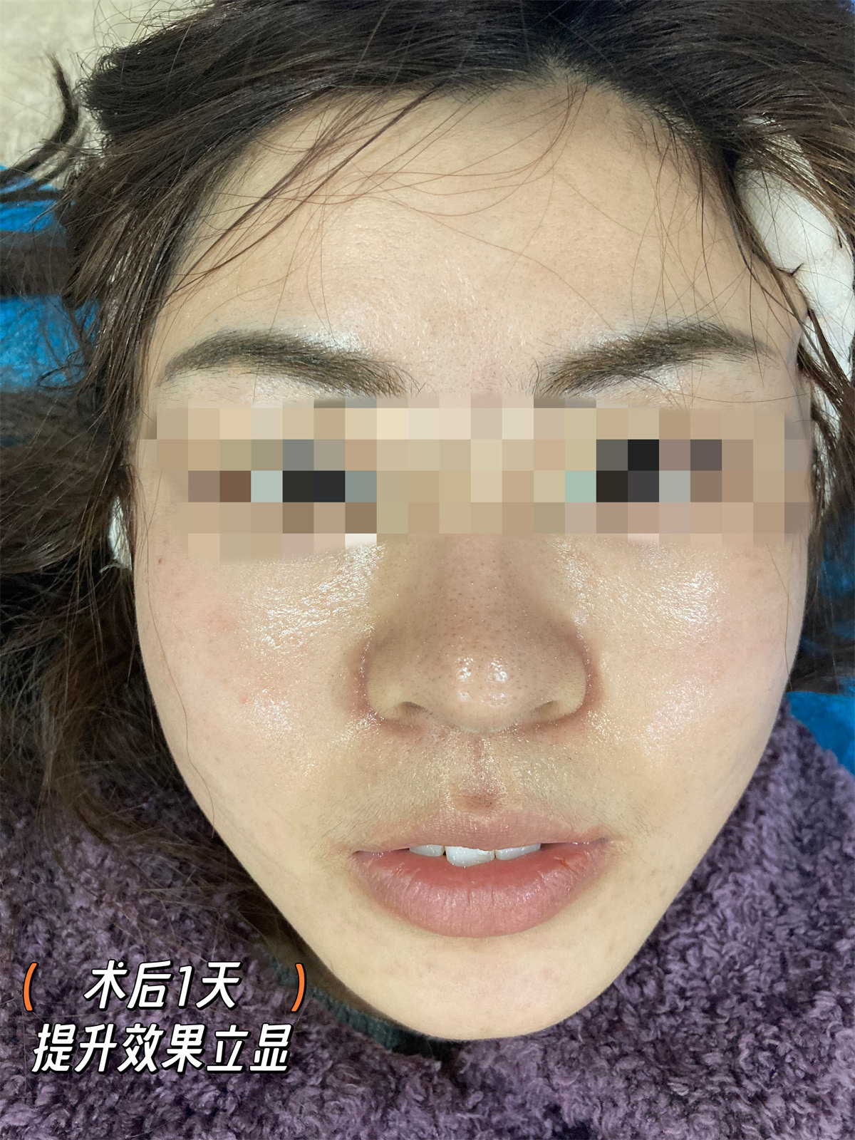 拉皮提升抗衰效果怎么样？两个案例供您参考