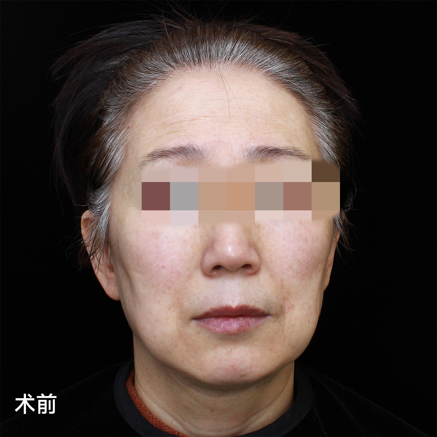 总被问有没有60岁！不甘心做了拉皮手术，第7天拍照，很惊喜