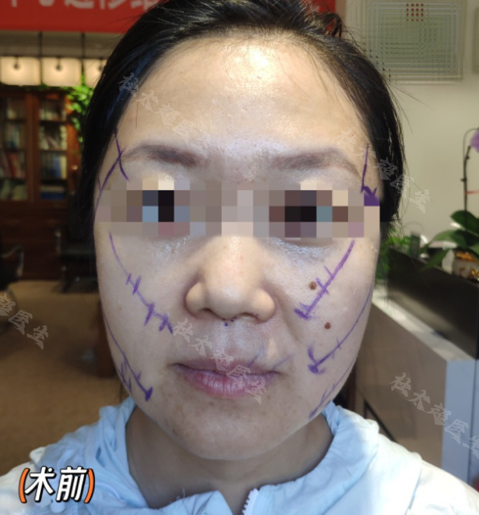 36岁做了拉皮手术，结合亲身感受，回复大家的3个问题！