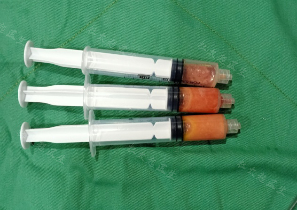 36岁做了拉皮手术，结合亲身感受，回复大家的3个问题！