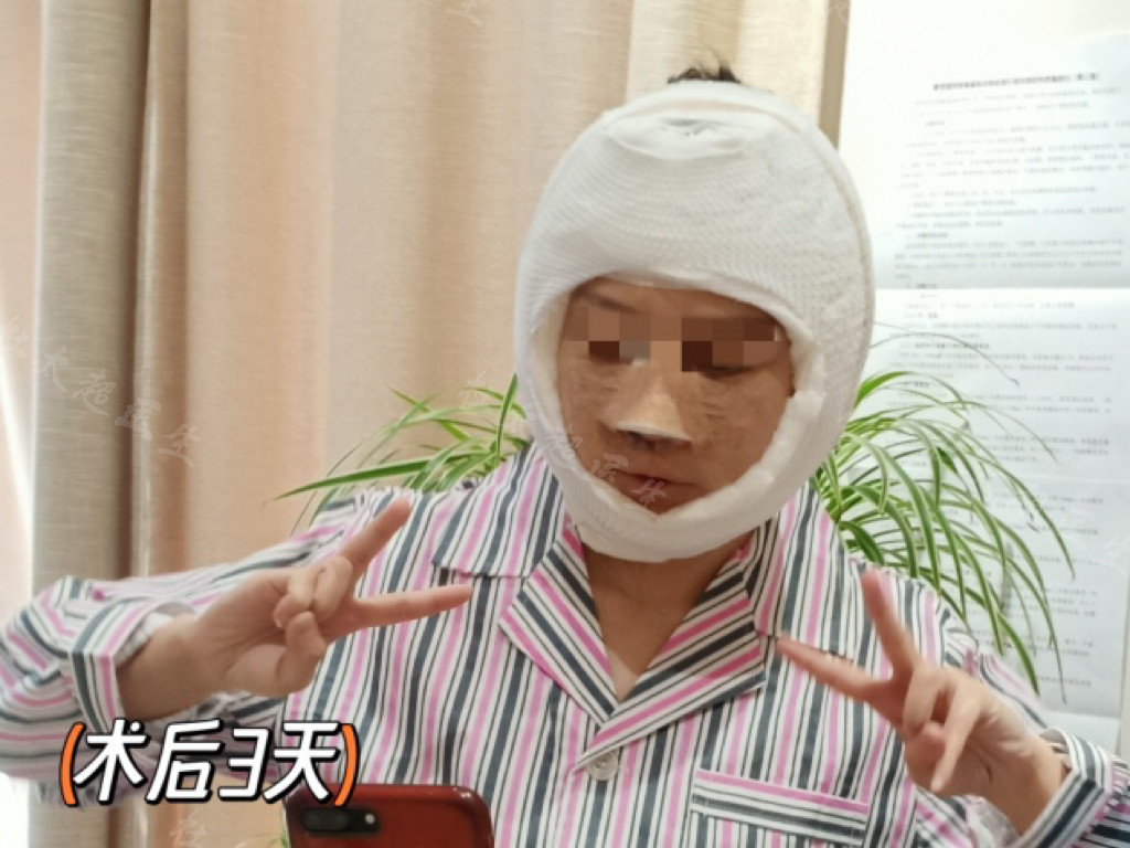 36岁做了拉皮手术，结合亲身感受，回复大家的3个问题！