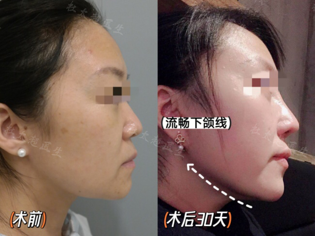 36岁做了拉皮手术，结合亲身感受，回复大家的3个问题！