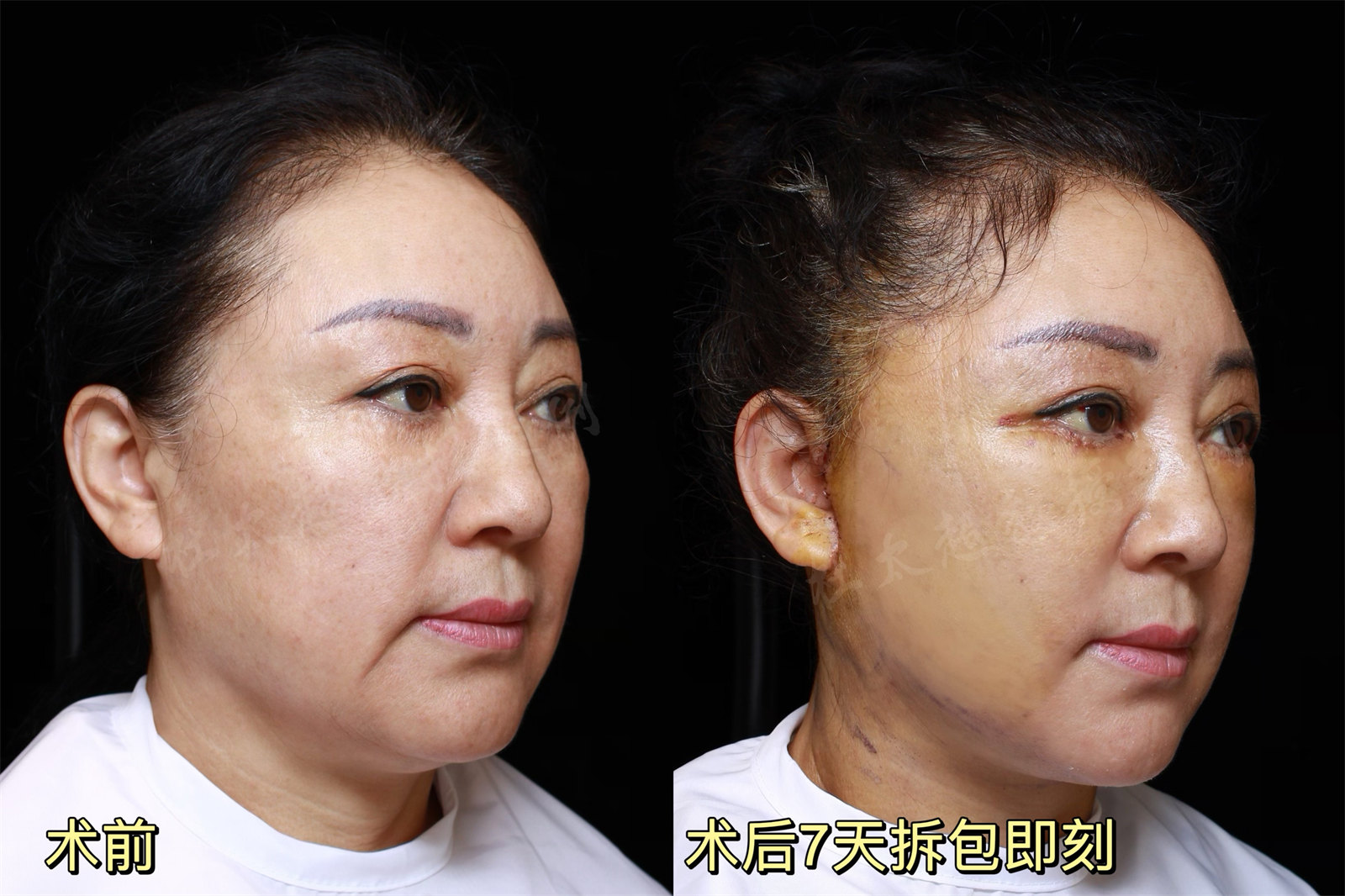 北京59岁女士，在女儿的支持下选择拉皮手术寻找真我！