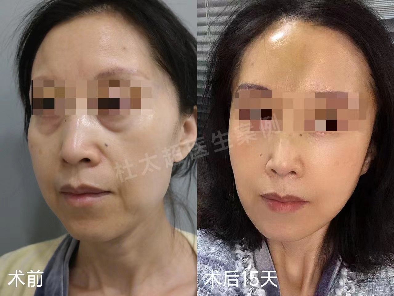3个真人案例，带你感受，拉皮手术到底能年轻几岁？