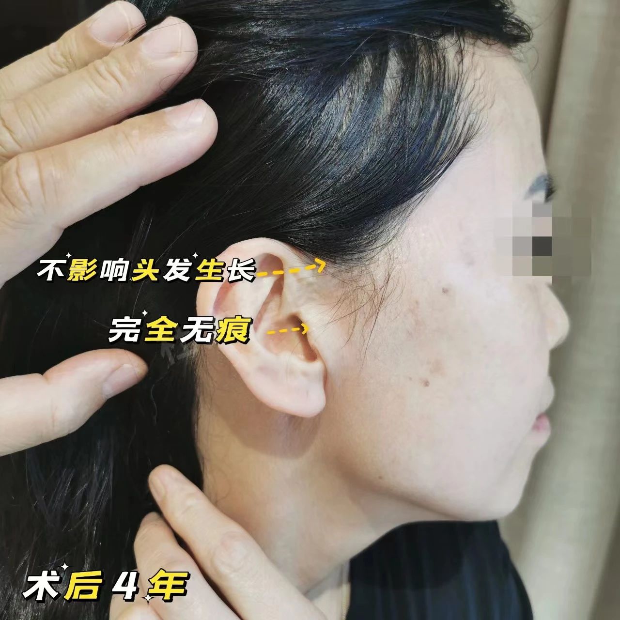 45岁，拉皮+去眼袋术后4年，状态比术前还要好