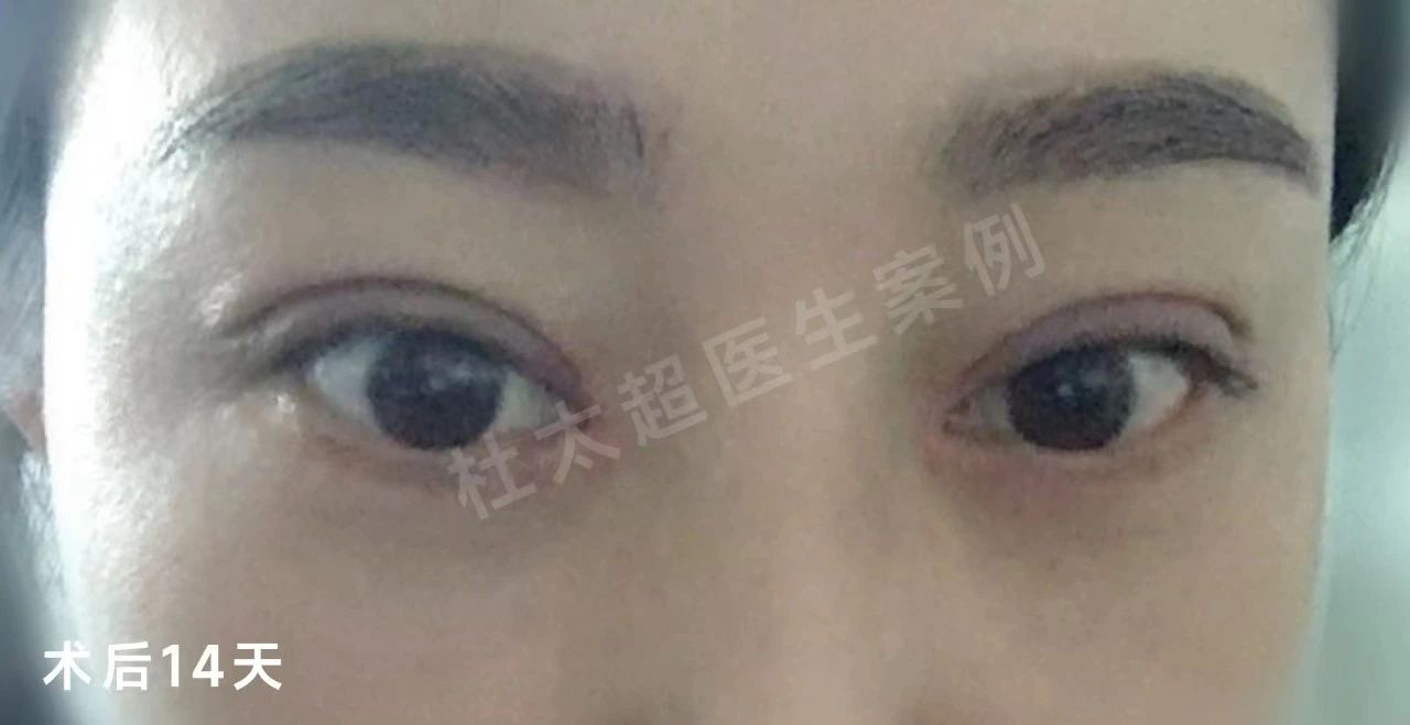 外切去眼袋+重睑修复案例分享，效果很明确！