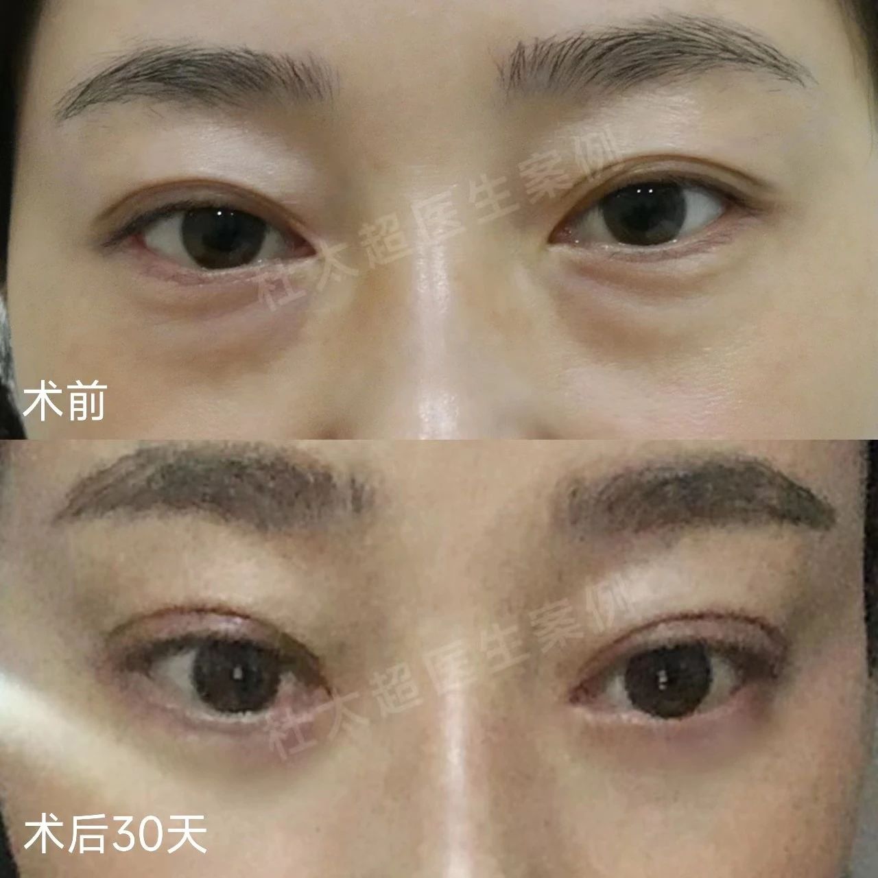 外切去眼袋+重睑修复案例分享，效果很明确！
