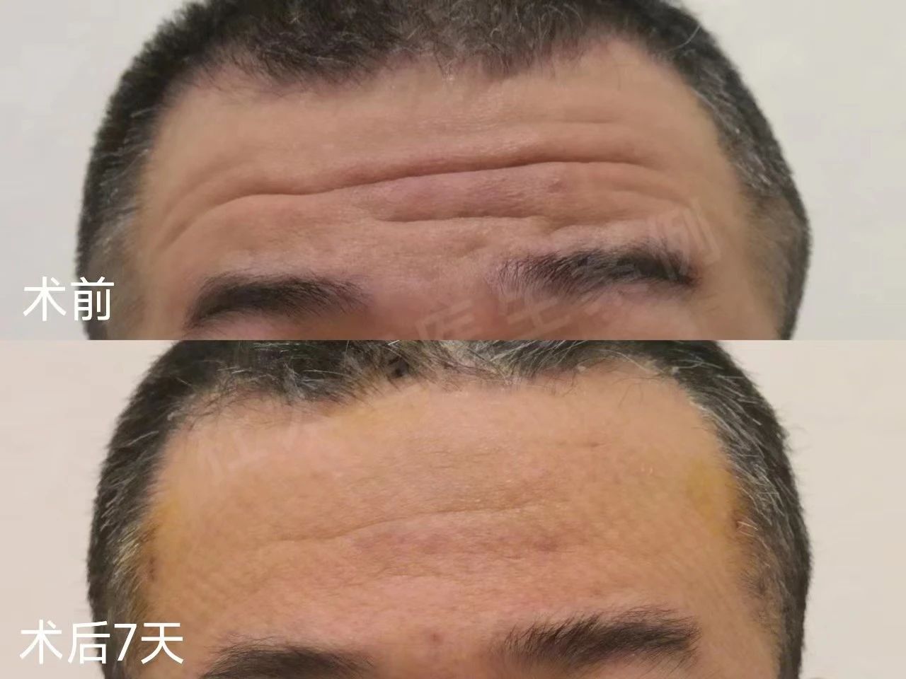 45岁男士额纹深邃，不接受大切口除皱，这样做有效改善！