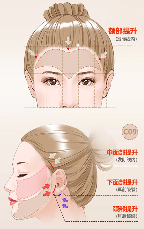 做完拉皮手术后需要坐飞机，可以正常出行吗？