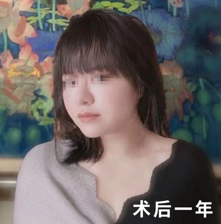51岁，拉皮手术的神奇效果，变化太大了！