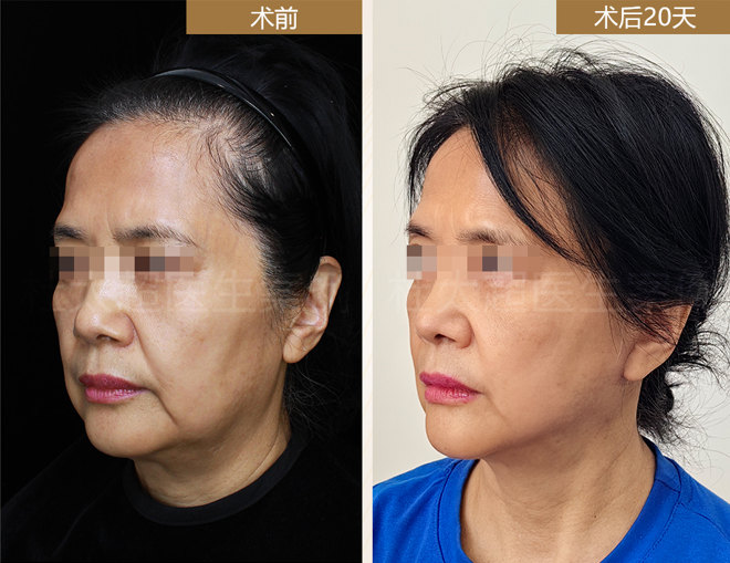 一直有口服抗凝药物的病史，能做拉皮手术吗？