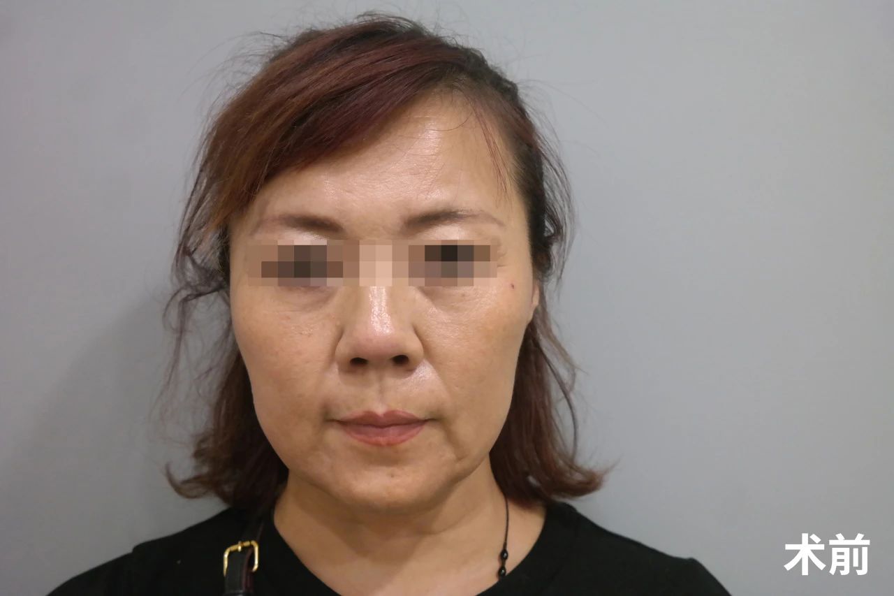 56岁又松又垮，瞒着家人来做拉皮手术+眼周抗衰，效果超预期！