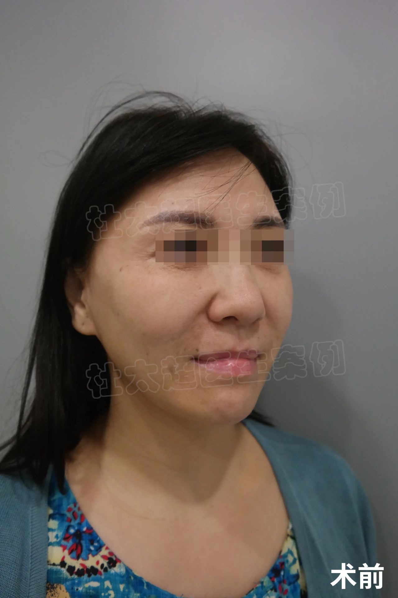 50岁拉皮手术蜕变之旅，术后半年改变惊人，找回青春不是梦