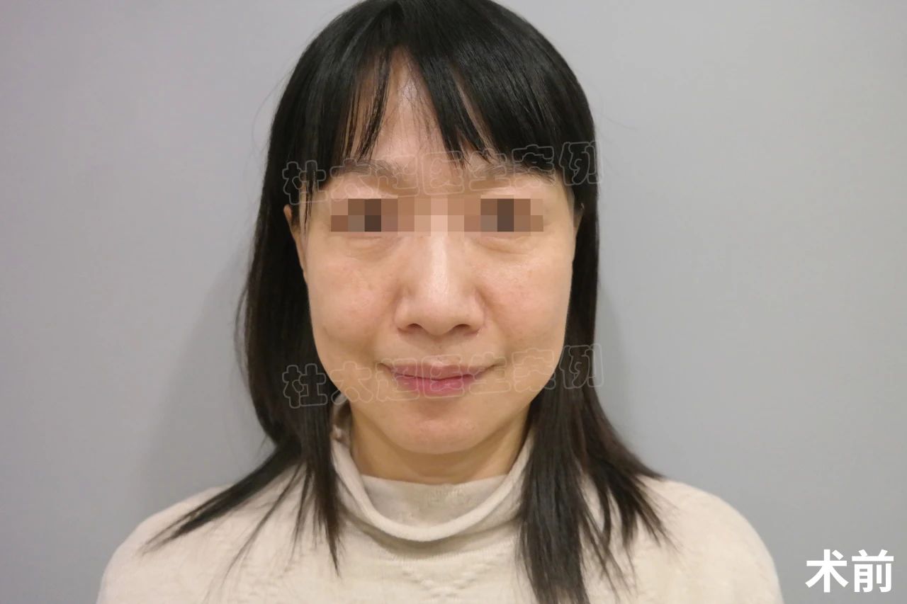 50岁拉皮手术，法令纹+面部松弛同时改善，效果清晰可见！