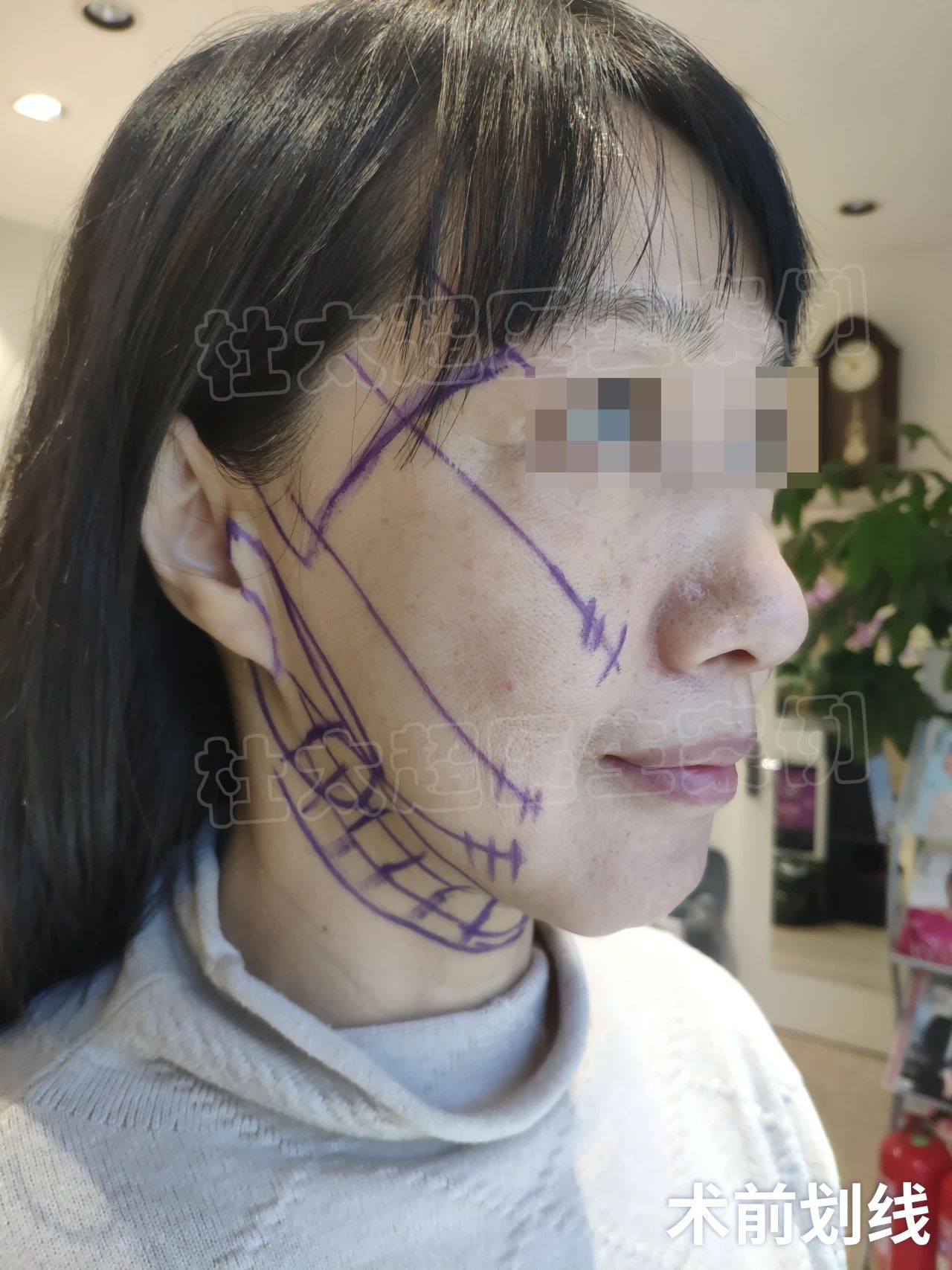 50岁拉皮手术，法令纹+面部松弛同时改善，效果清晰可见！