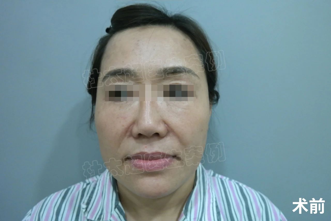 虽然恢复期过程充满了挑战，但我发现拉皮手术并没有传说中的那么可怕。只要在恢复期间保持乐观的心态，积极配合医生的指导，你会发现，美丽的蜕变就在前方等待着你！