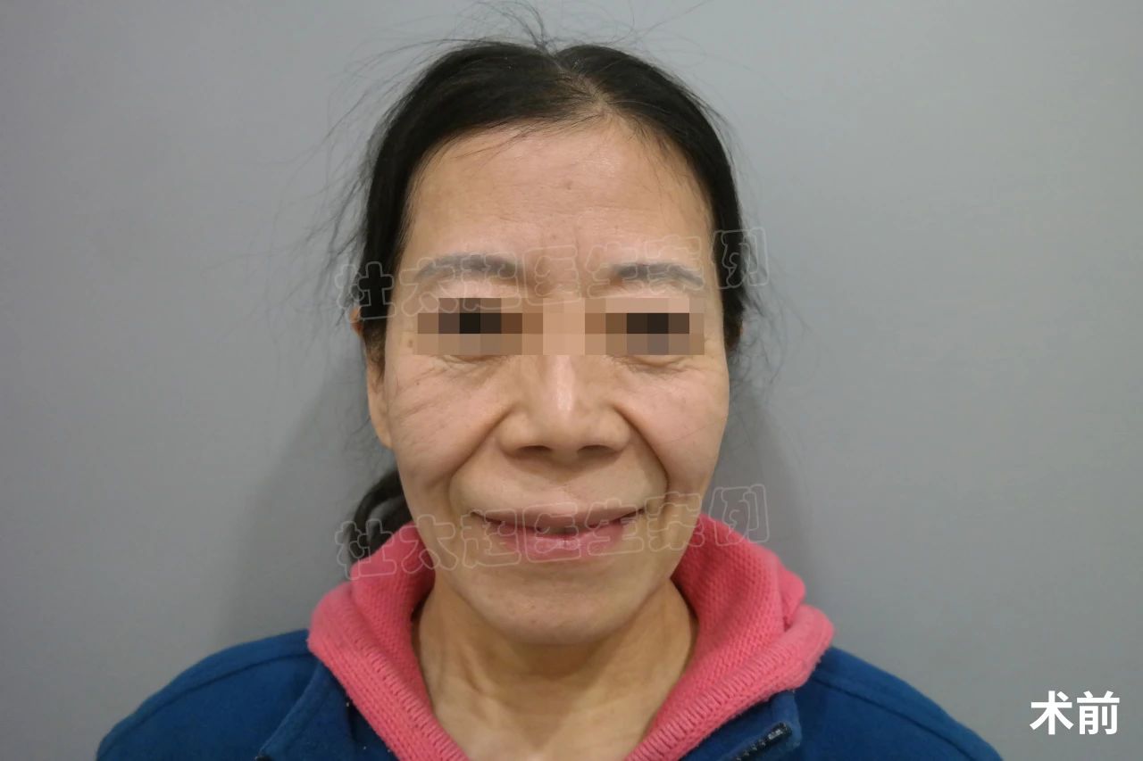 拉皮7天恢复成这样，看看她的经验分享，都是大实话！