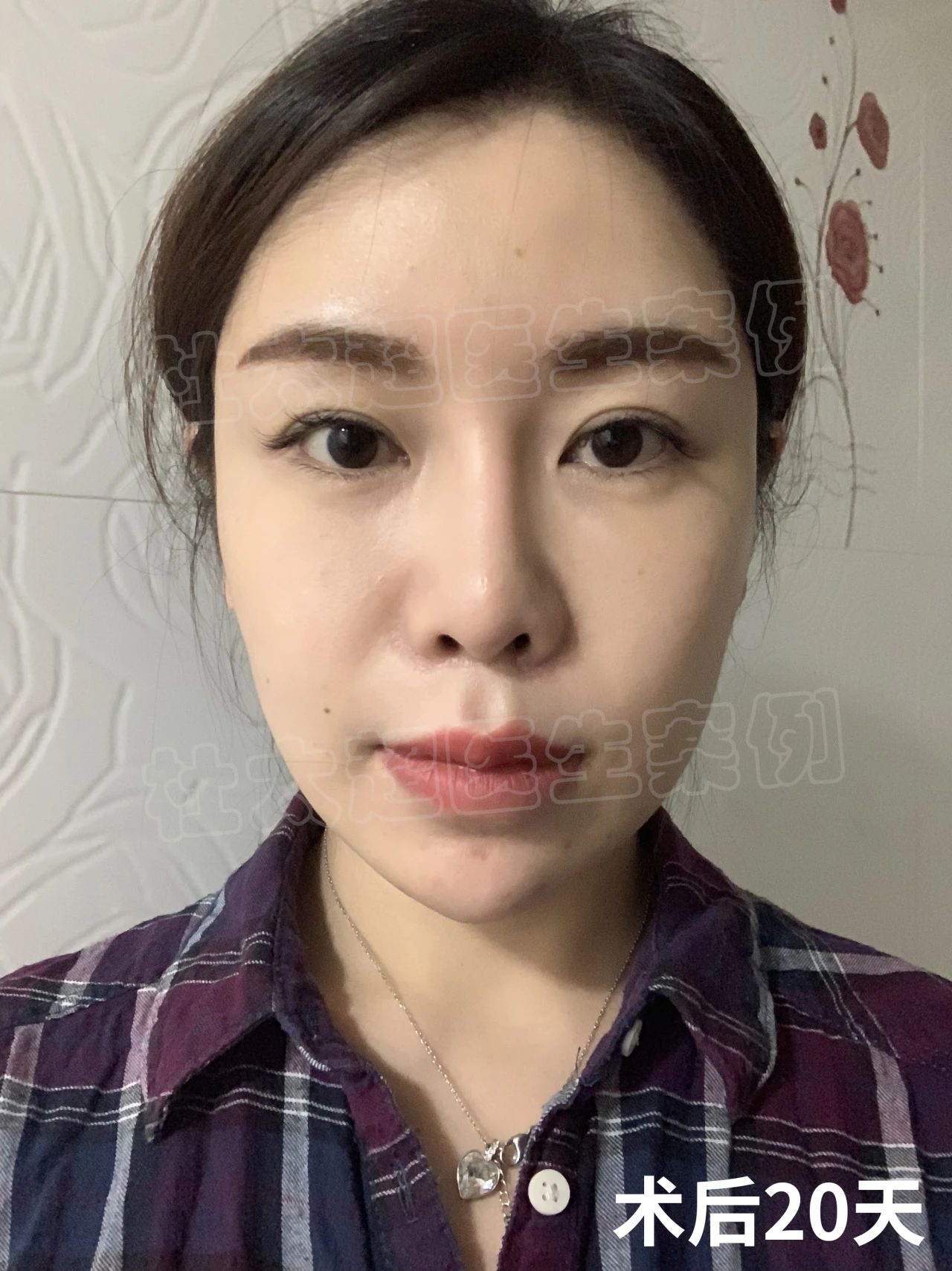 36岁抗初老，做了拉皮手术，术后自己很满意！