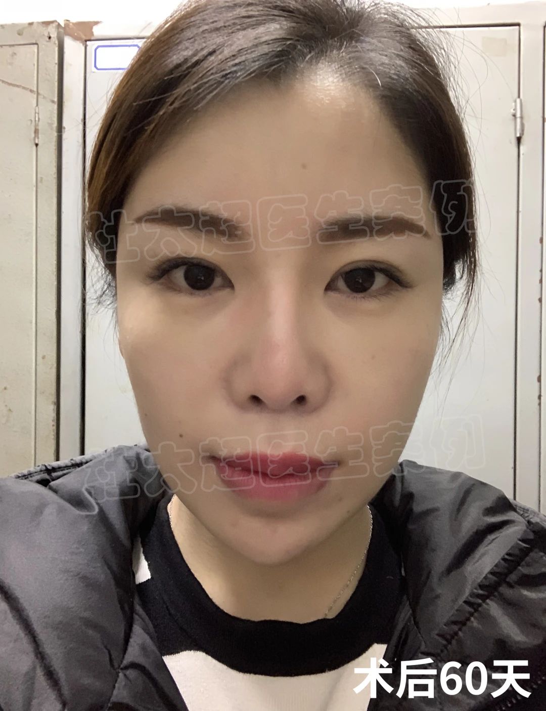 36岁抗初老，做了拉皮手术，术后自己很满意！