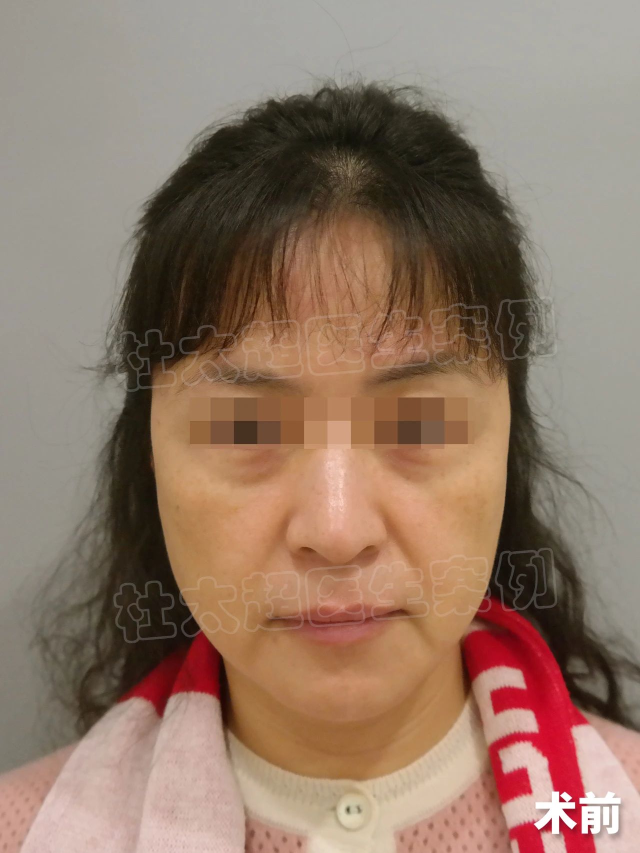 做拉皮会变成什么样，这是她术后的变化，找回了年轻自己！