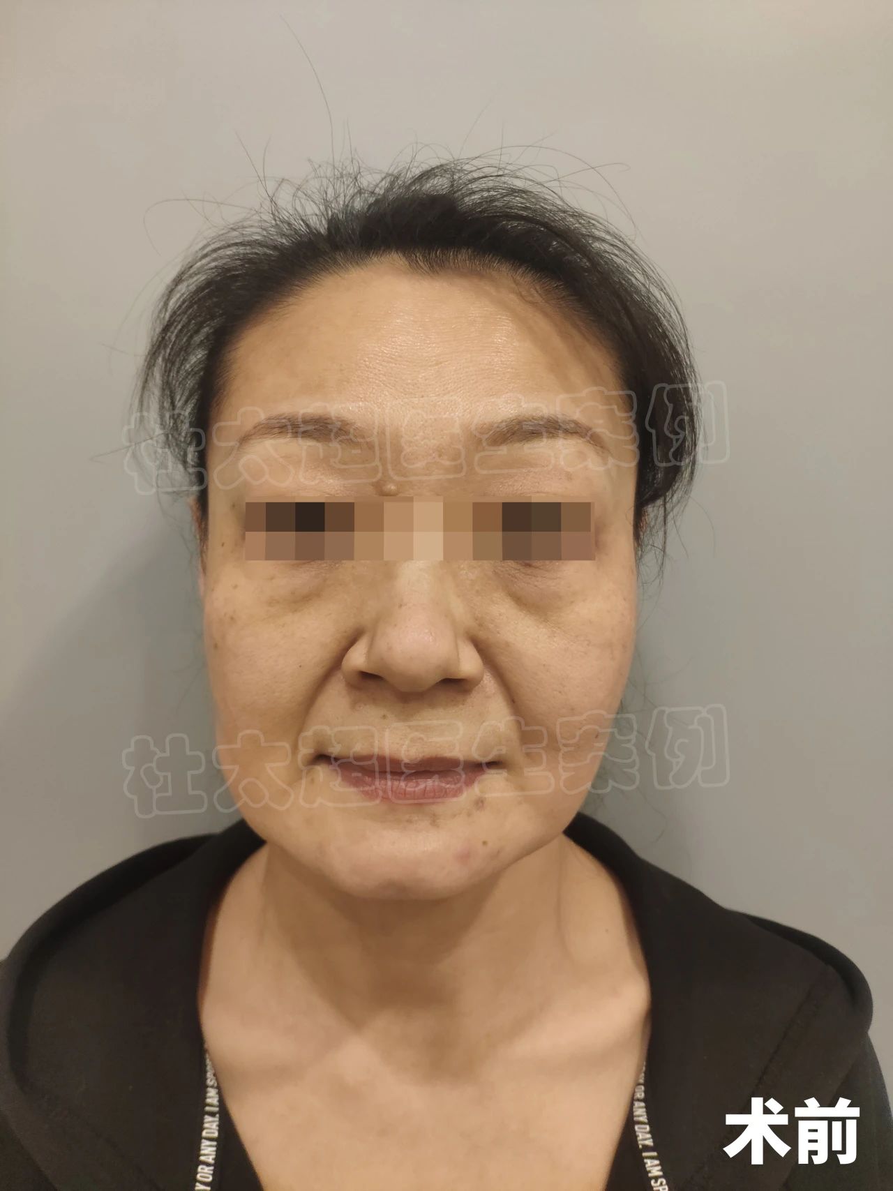 52岁做拉皮手术，谁能拒绝10岁的反差感？