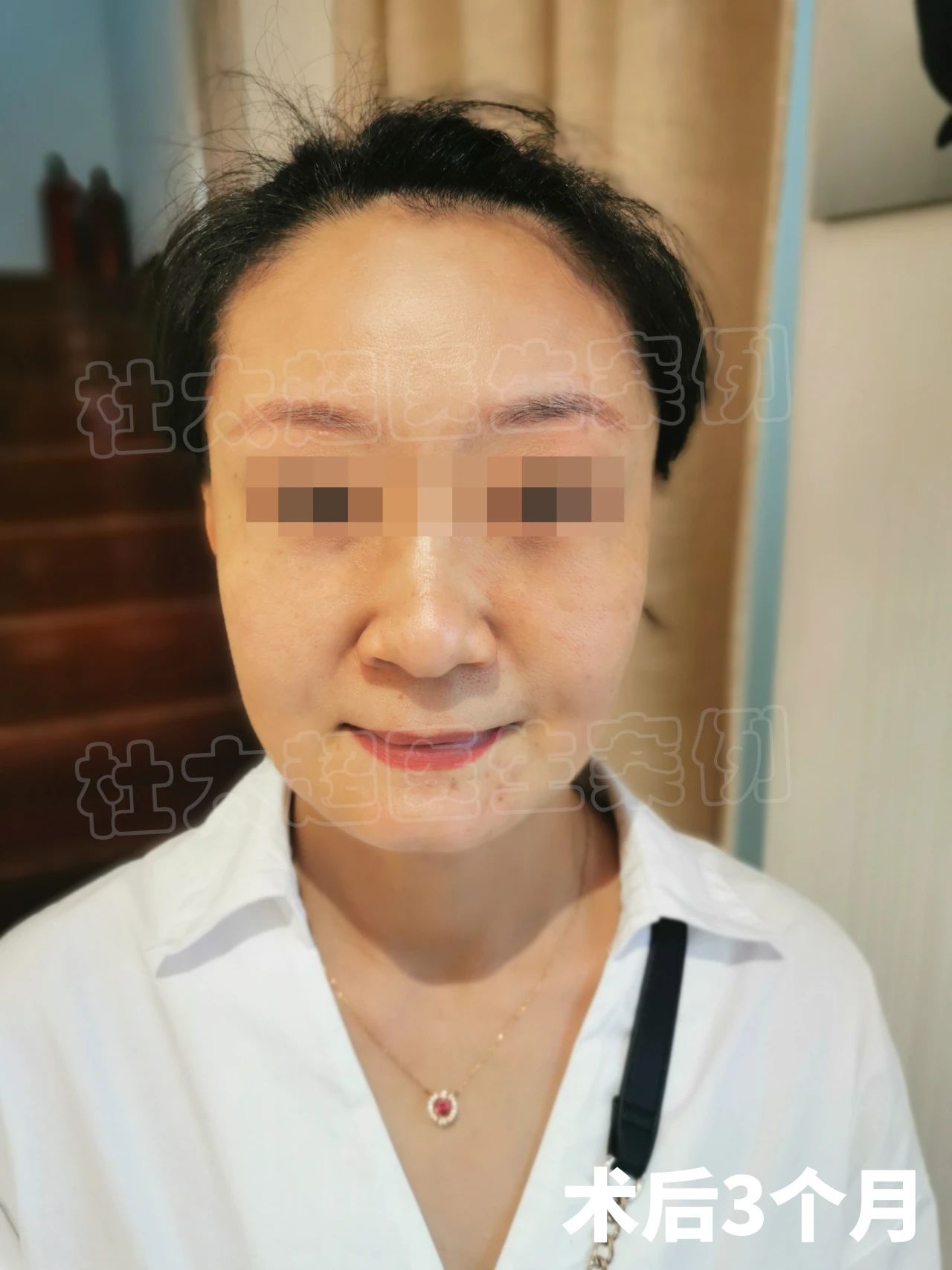 52岁做拉皮手术，谁能拒绝10岁的反差感？