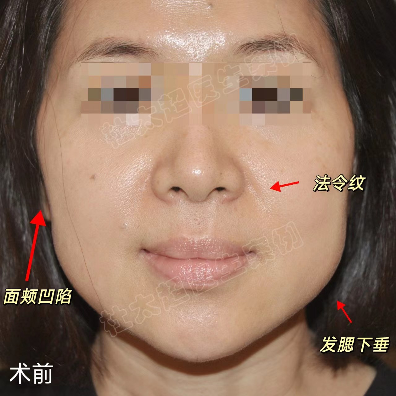 40岁肉肉脸女士做拉皮手术，效果如何？