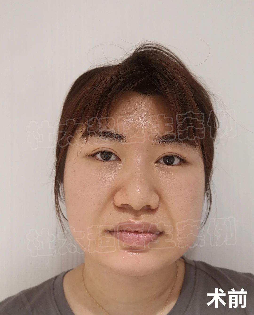 哪个女人不怕老，42岁拉皮手术，术后效果很满意