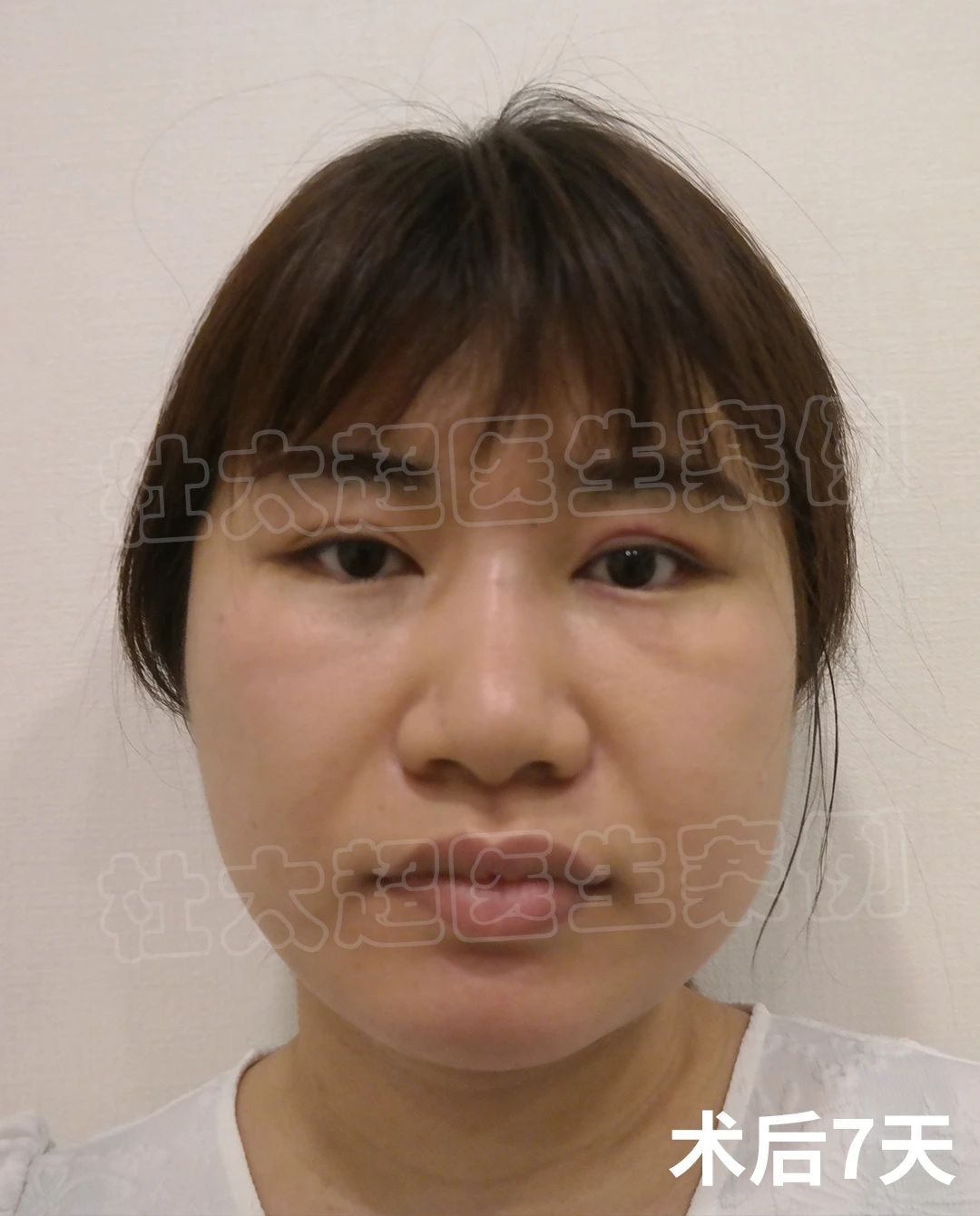 哪个女人不怕老，42岁拉皮手术，术后效果很满意