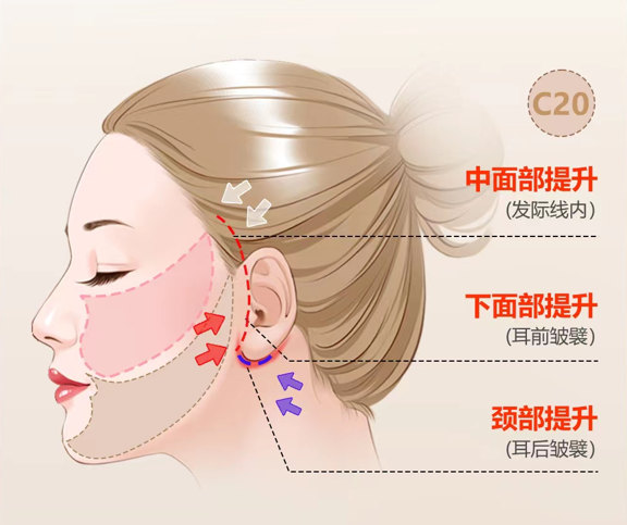 拉皮手术？这三类人一定不要做了！