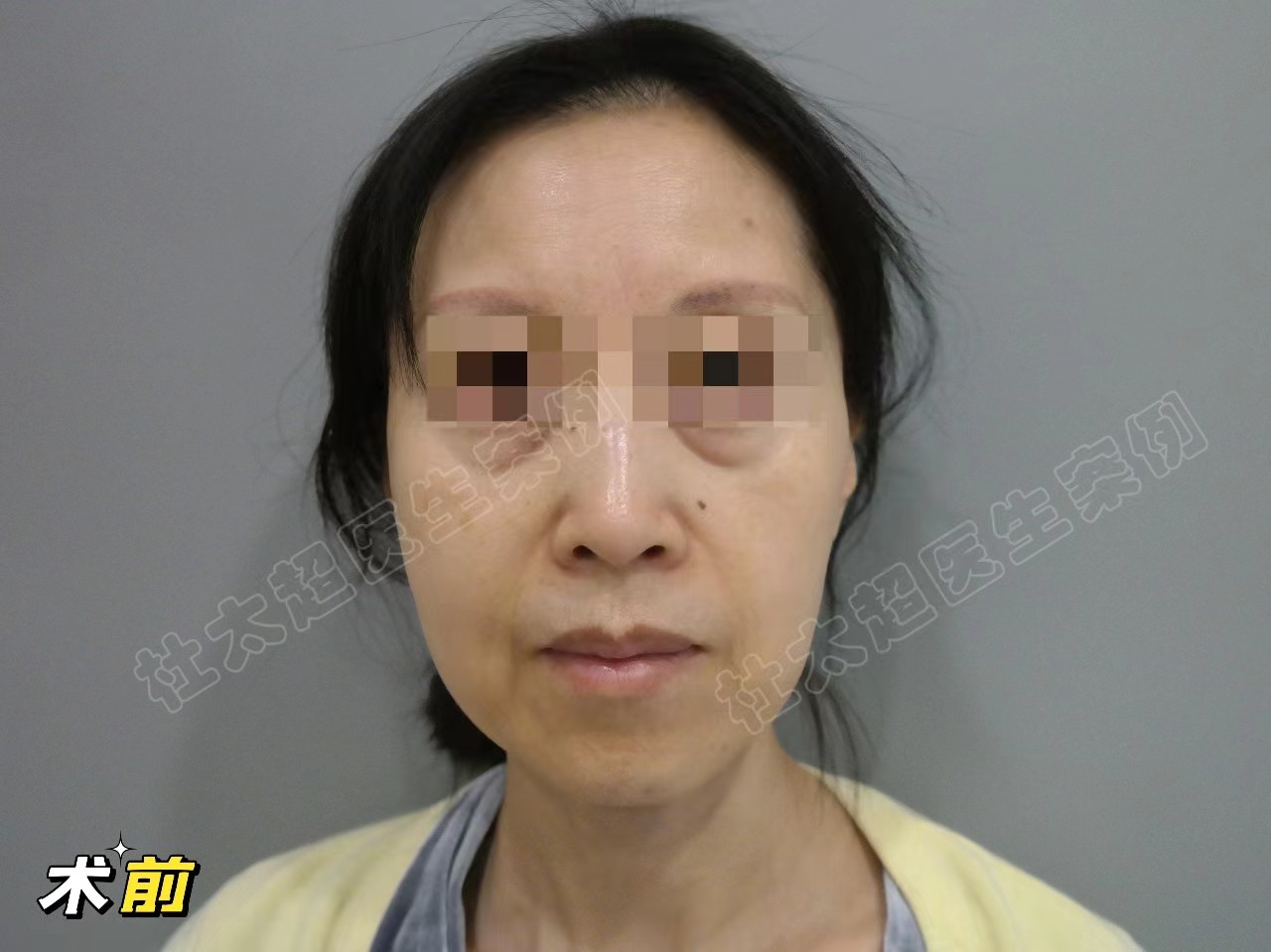 抗衰人士必看！拉皮手术的两种切口设计，各有千秋