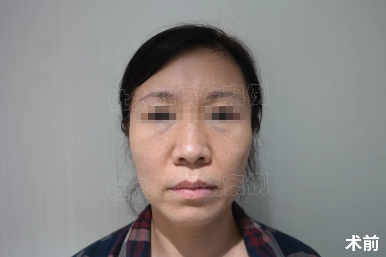 56岁求美者拉皮手术后，说了一句：真是白担心了