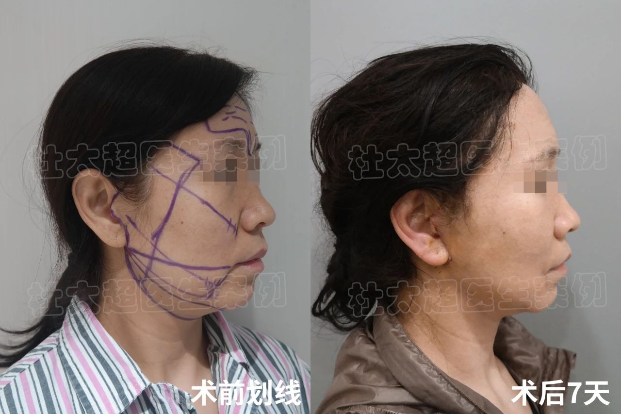 56岁求美者拉皮手术后，说了一句：真是白担心了
