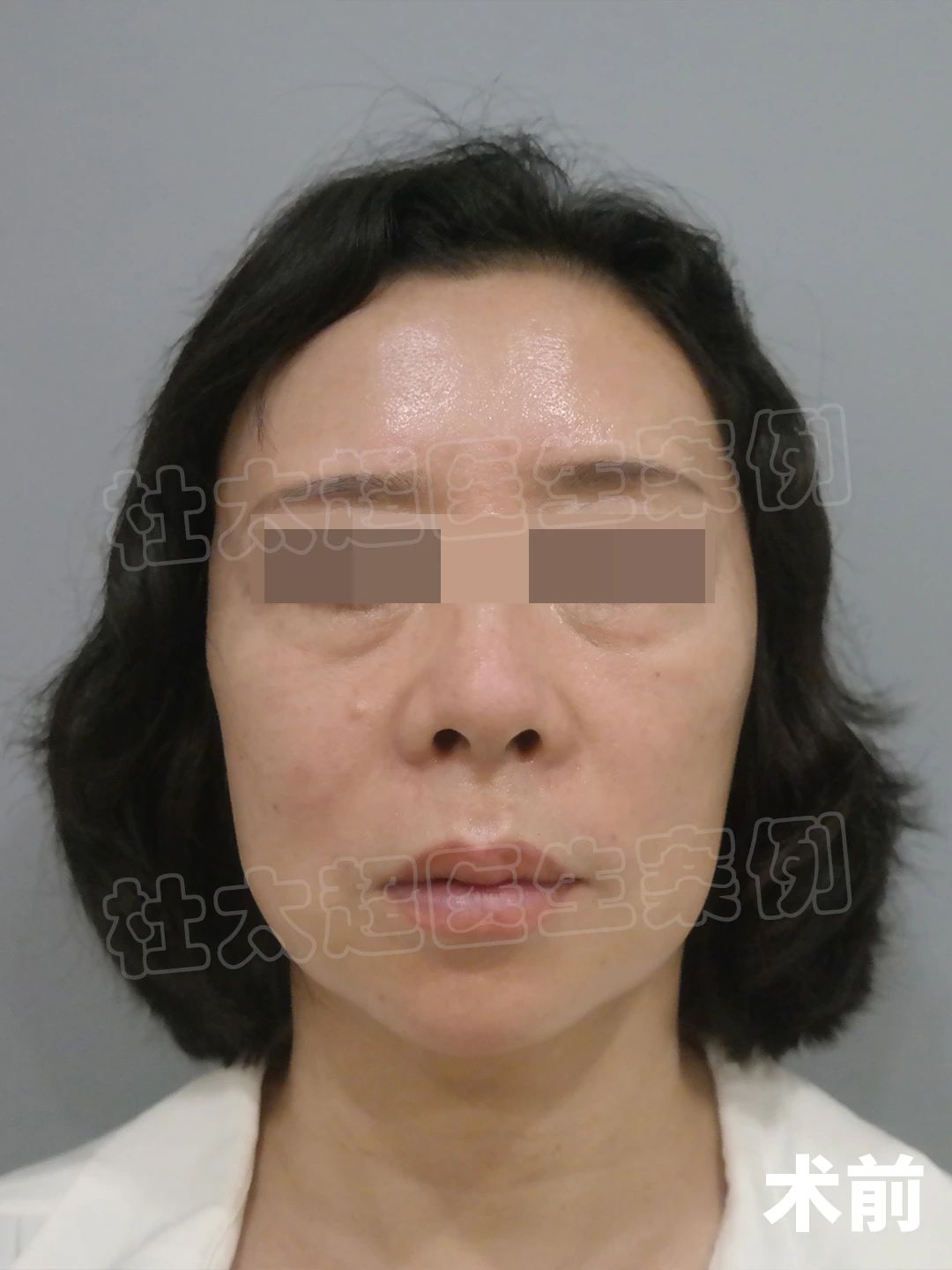 57岁拉皮手术，想说一些真心话，有可能得罪医生