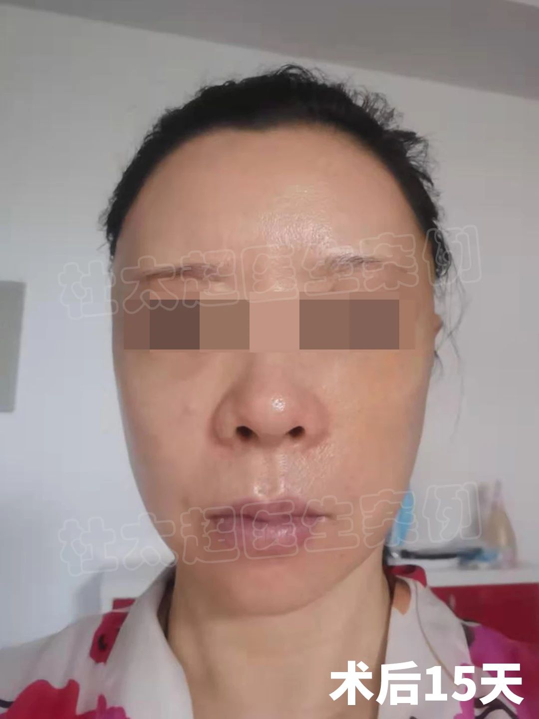 57岁拉皮手术，想说一些真心话，有可能得罪医生