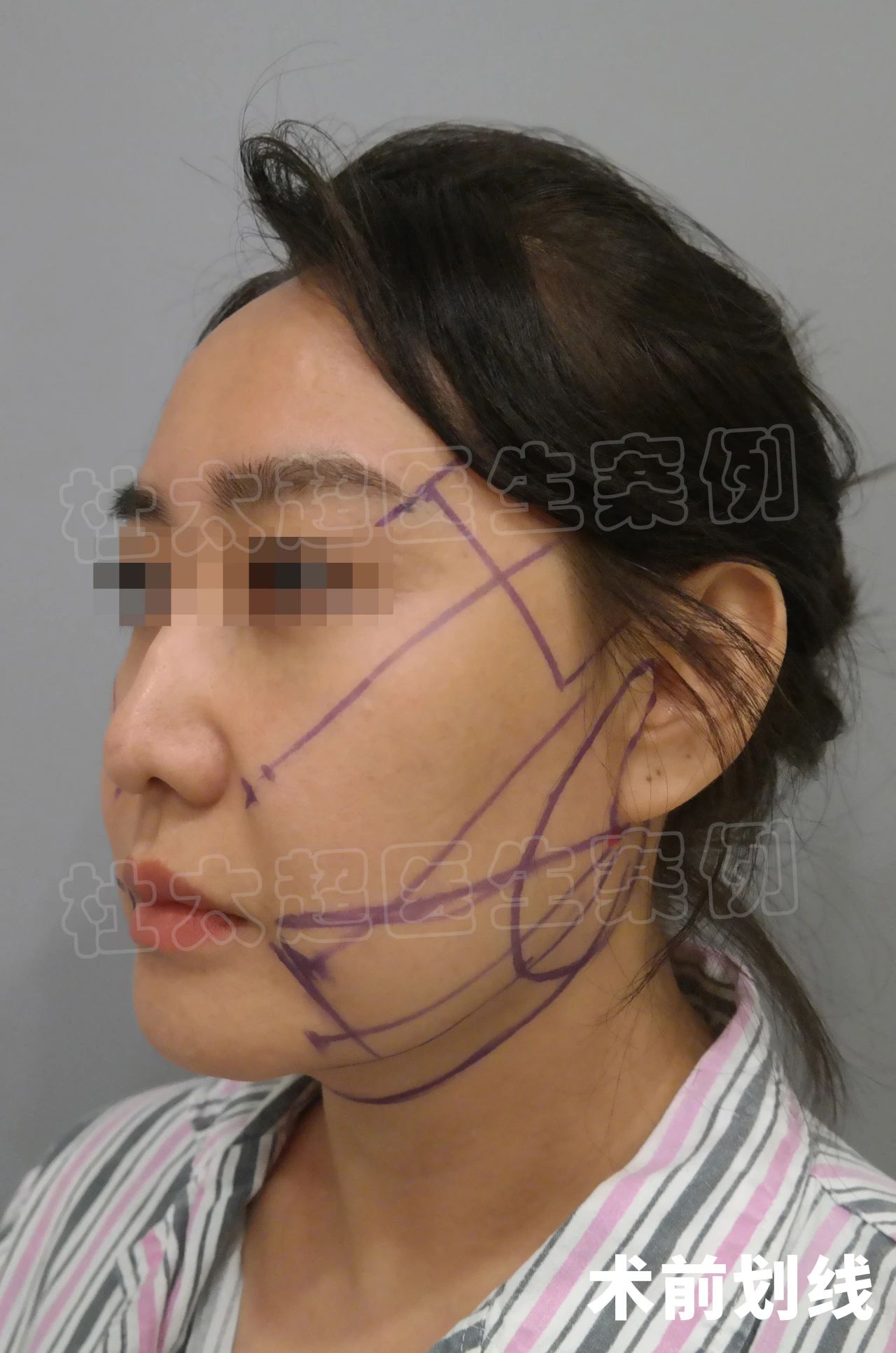 44岁就比同龄人显老，做完拉皮手术，直言：一切都很值得