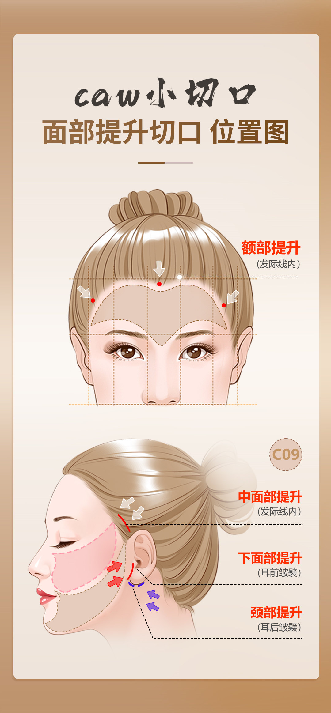 一篇文章，带你了解什么是caw小切口面部提升术？