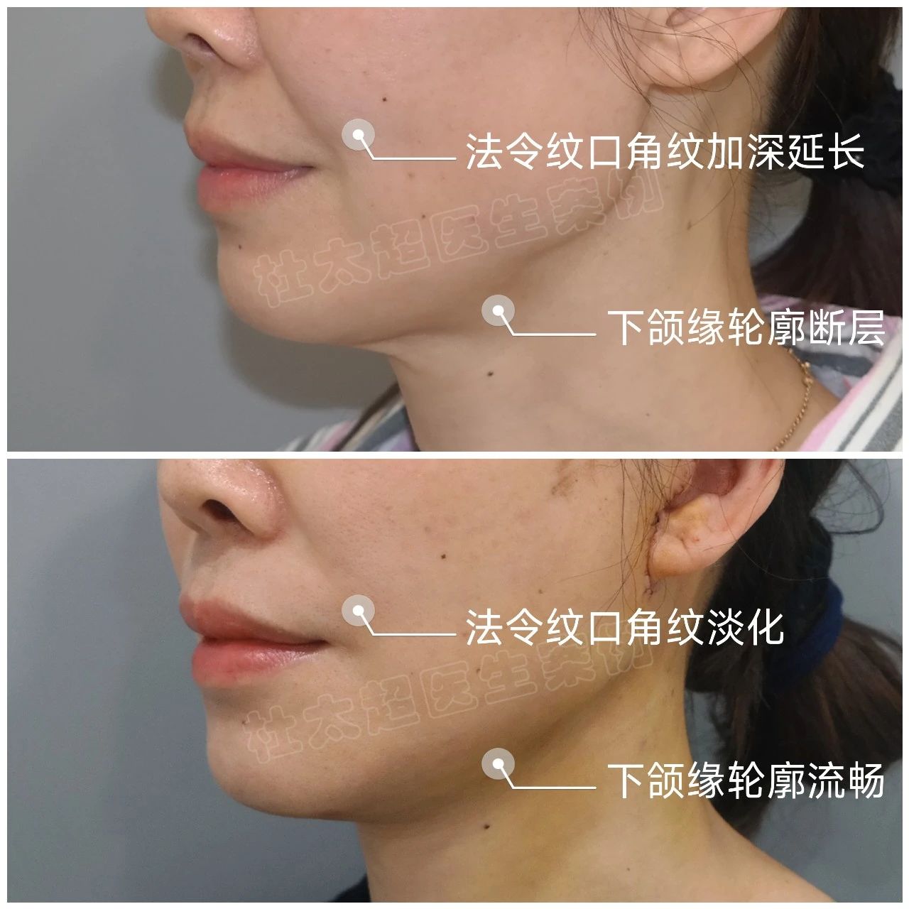 下颌缘塑型——揭秘手术优势与隐患！