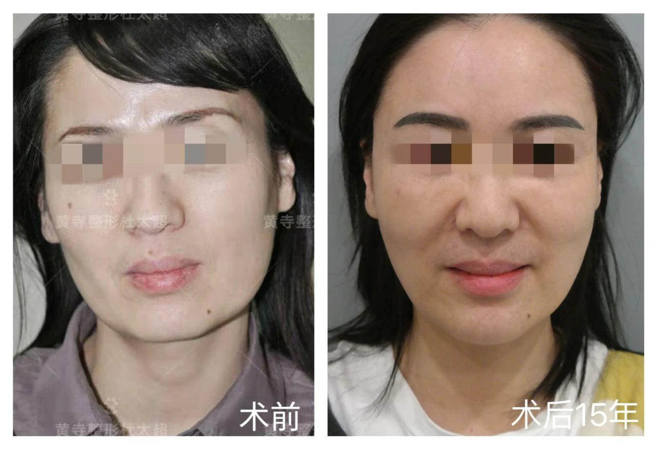 十五年！两次拉皮手术挑战岁月，对杜太超医生的敬佩与信赖！