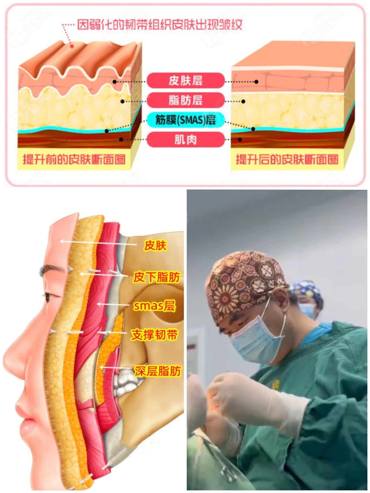 拉皮手术价格越高效果越好？小心入了低价手术的坑！