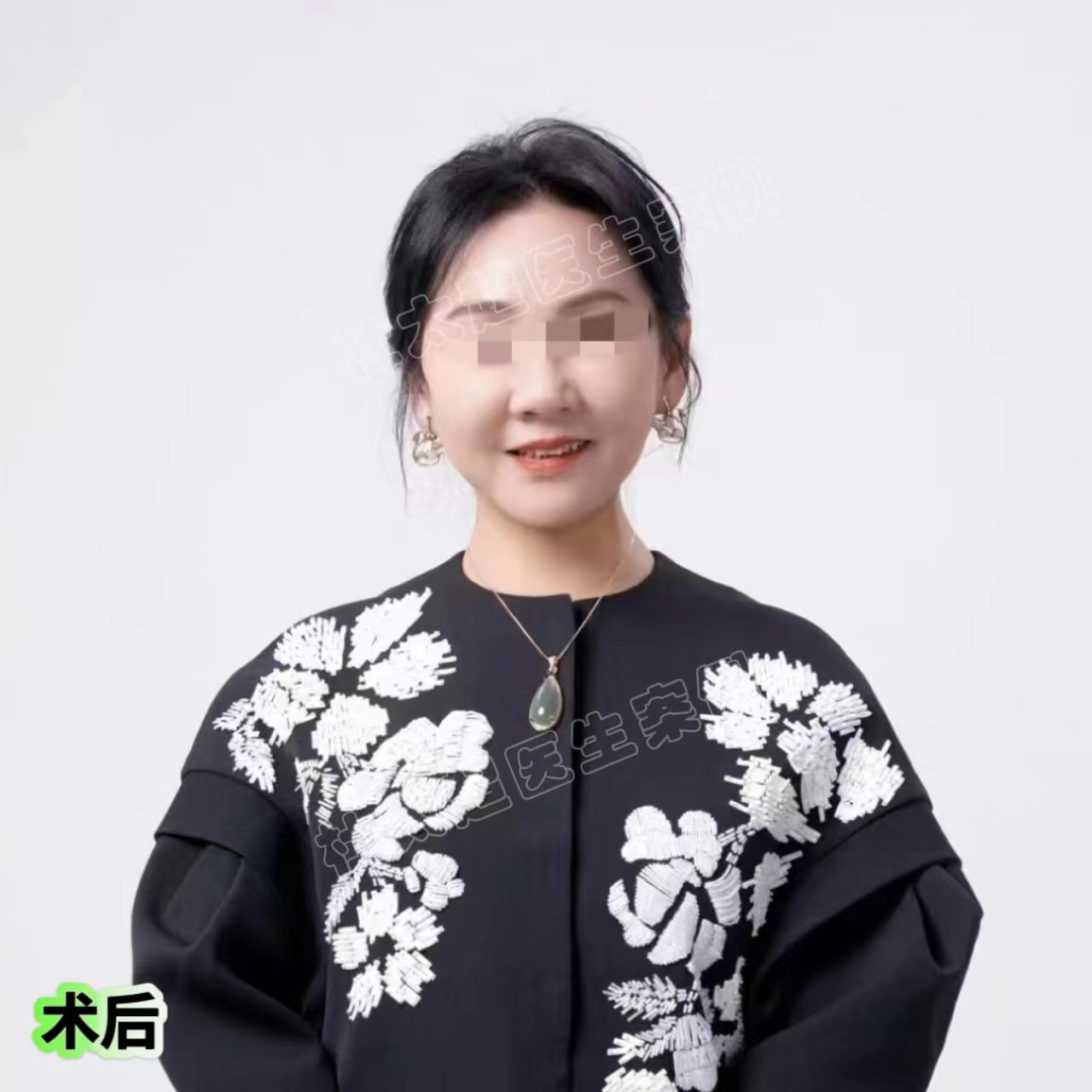 安享晚年的年纪做了拉皮手术，结果爆改成功！