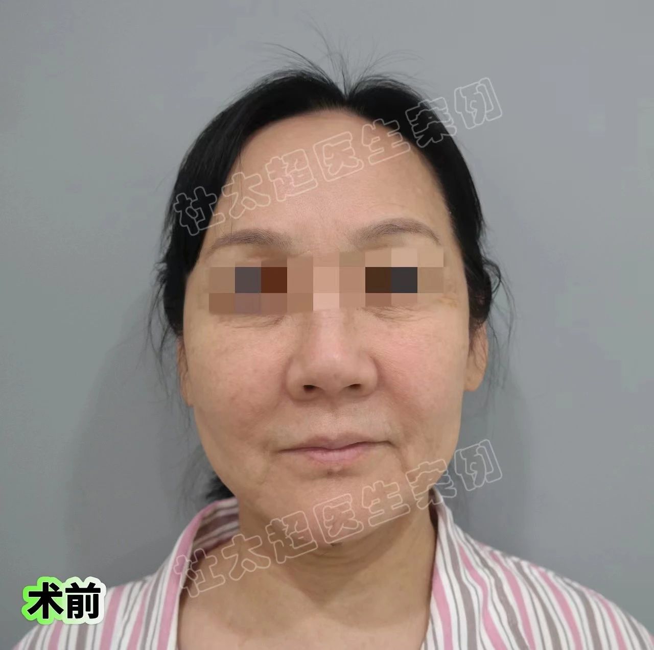 拉皮哪家强？60多了还“疯”，倔强选择拉皮手术！