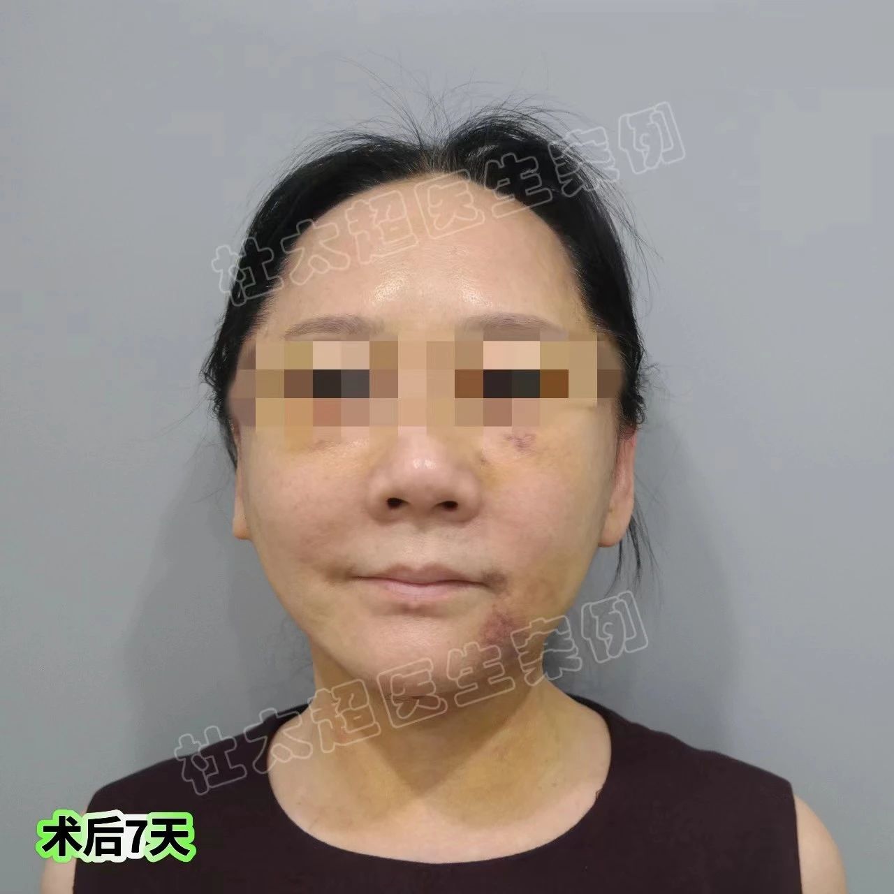 拉皮哪家强？60多了还“疯”，倔强选择拉皮手术！