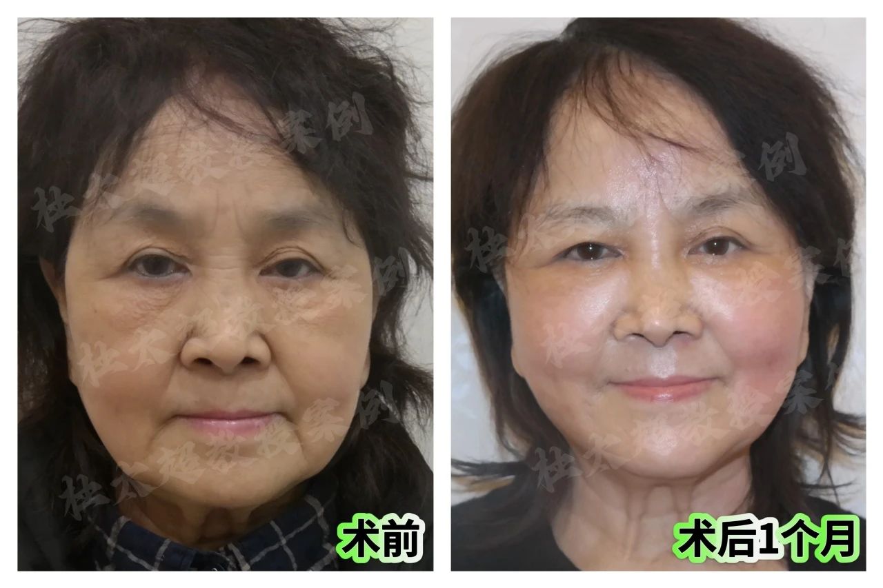 拉皮手术多大年龄适合做？惊呆了！70岁的一次青春重燃之旅！